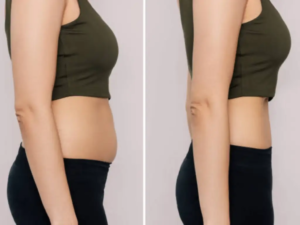 Emsculpt Neo Side Effects