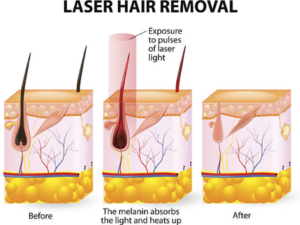 full face laser hair removal