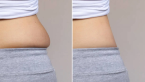 Laser Lipo vs Cavitation