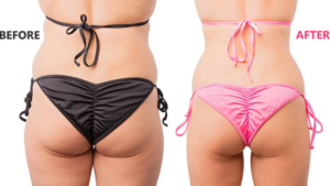 Laser Lipo vs Cavitation