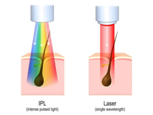 Diode Laser or IPL 3