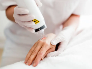 Diode Laser or IPL