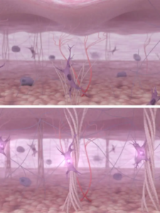 What Is RF Skin Tightening