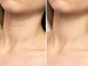 What Is RF Skin Tightening 1