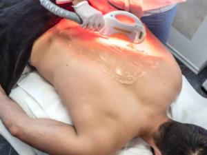 Laser Hair Removal 2