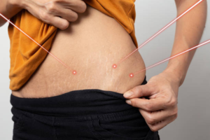 Laser Lipo